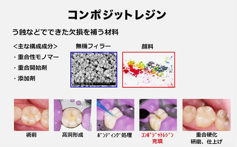 わかる！できる！コンポジットレジン修復 わかる！できる！ 決定版コンポジットレジン修復/医歯薬出版株式会社
