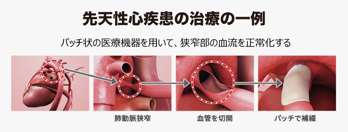 先天性心疾患の再手術を減らす心血管パッチを実現―第57回日化協技術賞